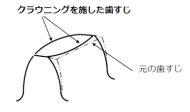 クラウニング